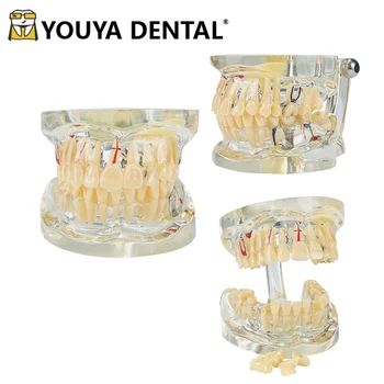 Модель обучения зубам, патологическая модель для взрослых с имплантатом для студентов-стоматологов, изучающих Инструменты общения врача и пациента